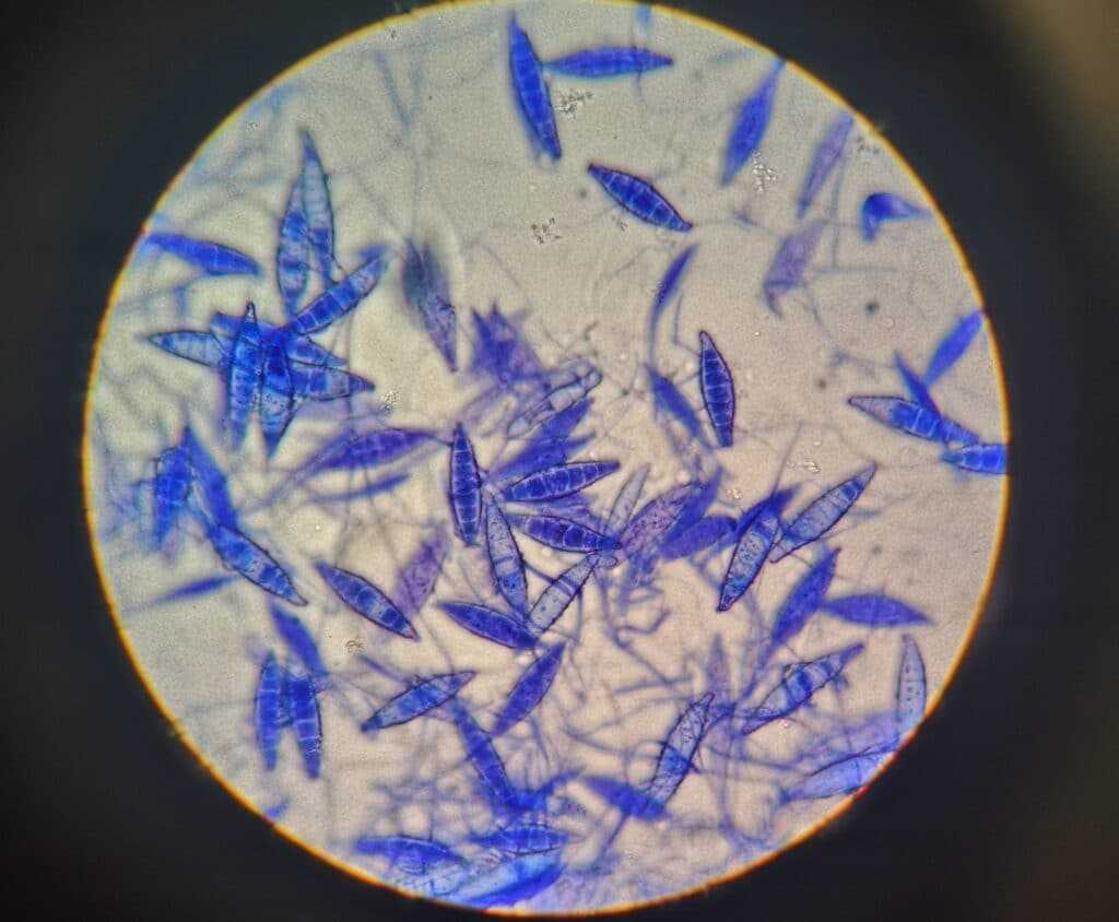 La tiña de Tina: dermatofitosis y tratamiento fitoaromaterápico adyuvante.